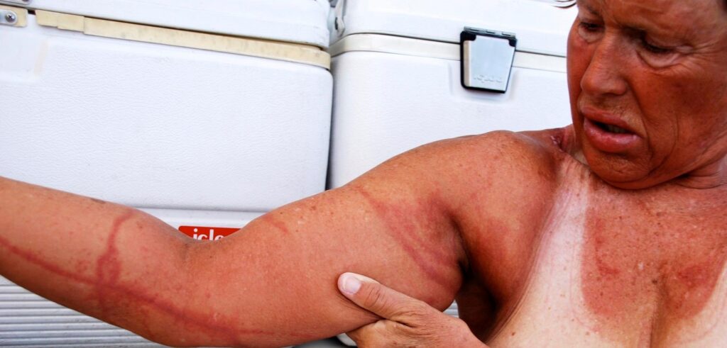 Diana nyad jellyfish sting