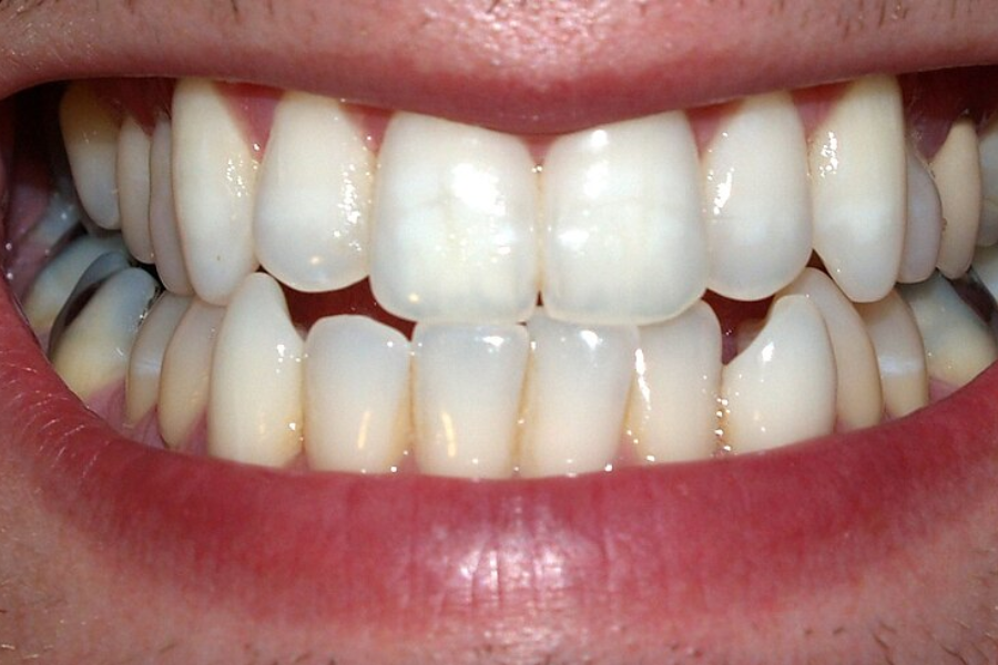 Open mouth teeth